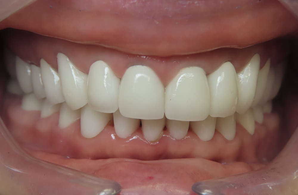 A close up of a person 's mouth with white teeth.