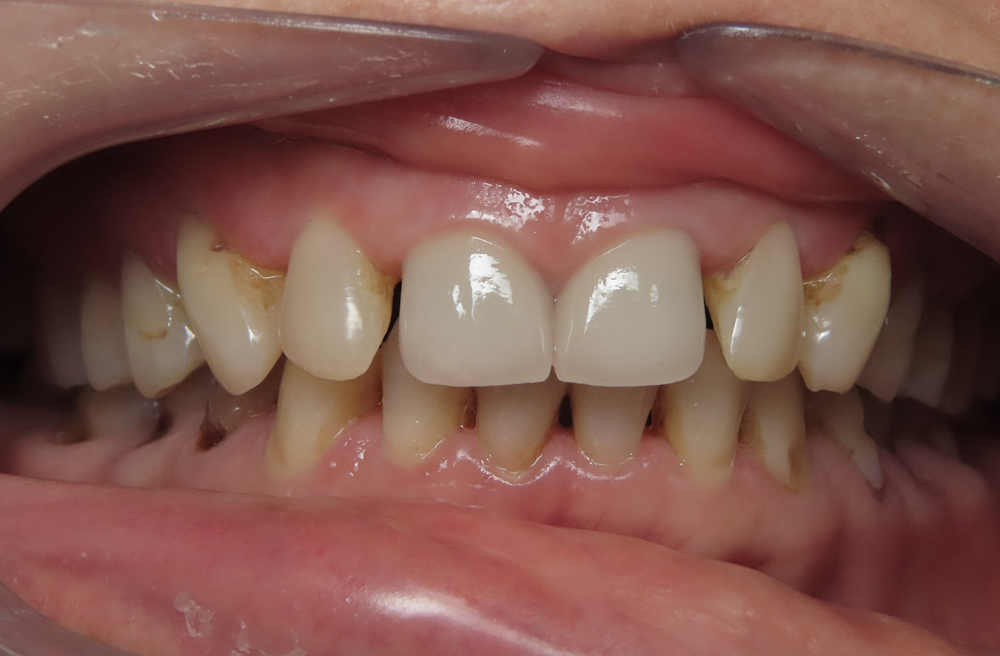 A close up of a person 's teeth with a mouth guard.