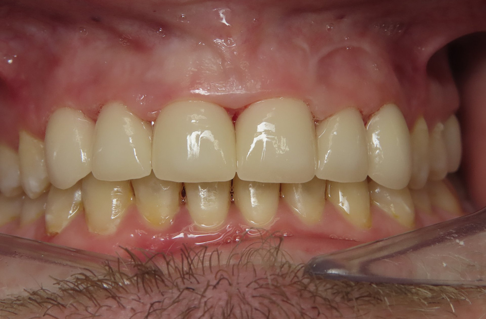 A close up of a man 's teeth with a clear plastic covering.