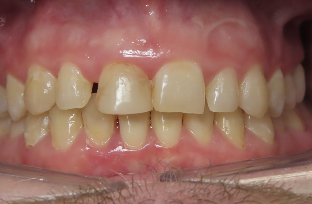 A close up of a man 's mouth showing his teeth.
