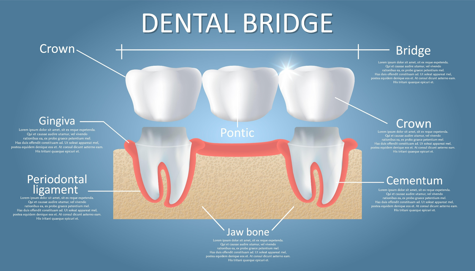 Woman holding a dental model showing a tooth implant, smiling. Blue background, white lab coat.
