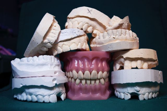 Pourquoi un bridge dentaire ?  Cabinet Dentaire Castellane 13006.