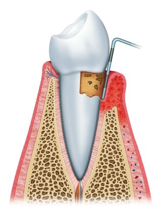 Gum Disease treatment in Vegreville