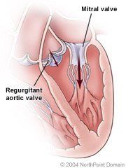 As the mitral valve opens to fill the left ventricle with blood, an regurgitant aortic valve allows blood to leak backward into the ventricle. As the mitral valve opens to fill the left ventricle with blood, an regurgitant aortic valve allows blood to leak backward into the ventricle.