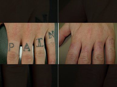 tattoo removal experts