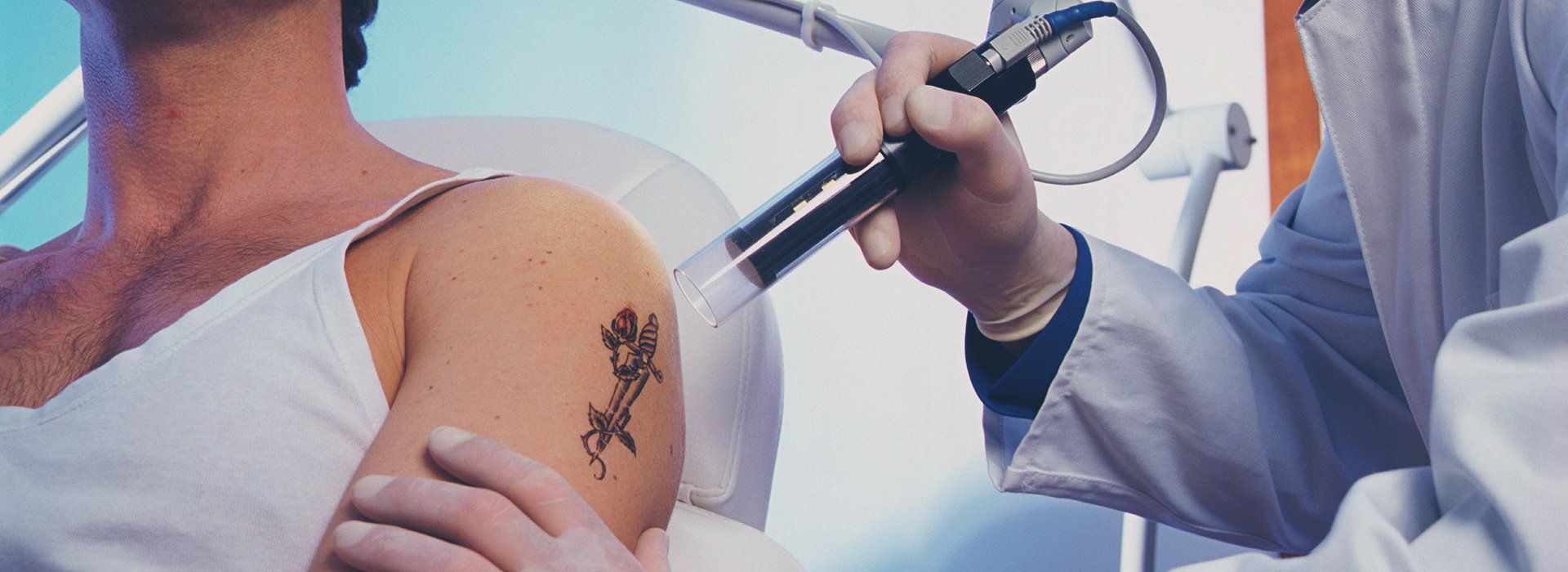 Permanent Tattoo Removal in Chennai | Pico laser tattoo removal