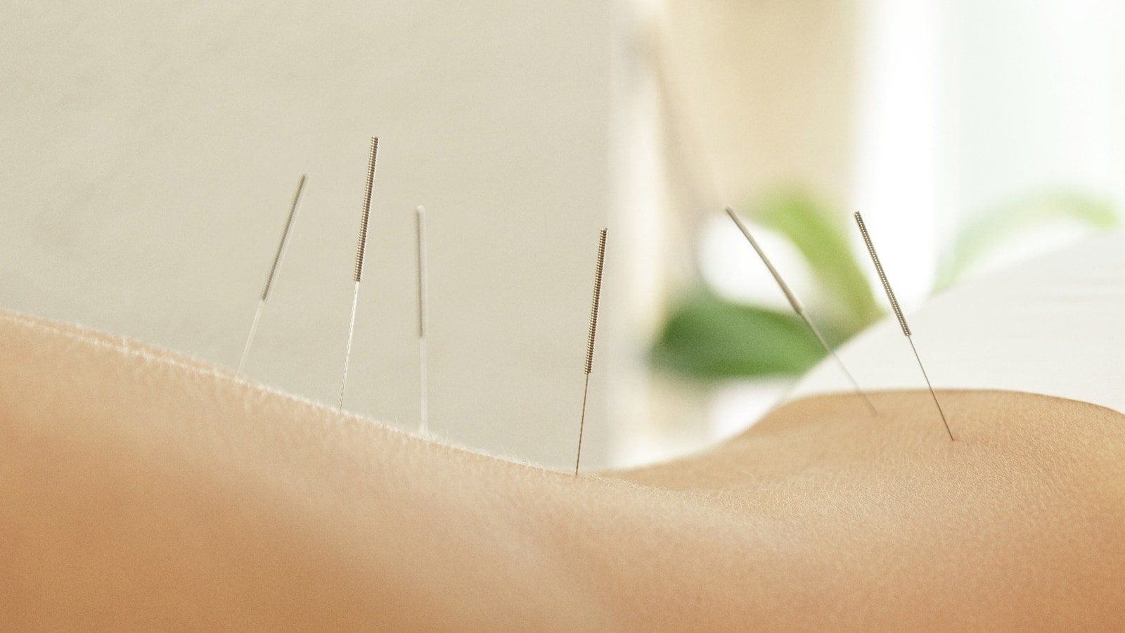 Medical Acupuncture