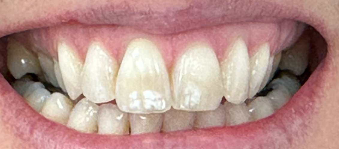 A close up of a person 's mouth with white teeth.