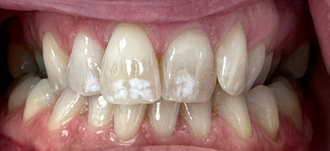 A close up of a person 's teeth with white spots on them. before