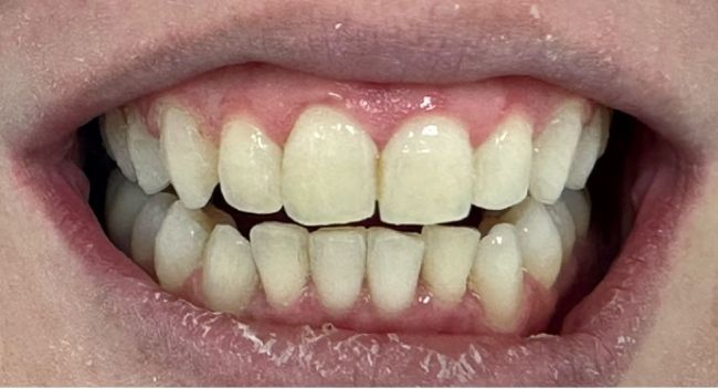 A close up of a person 's mouth showing their teeth. After