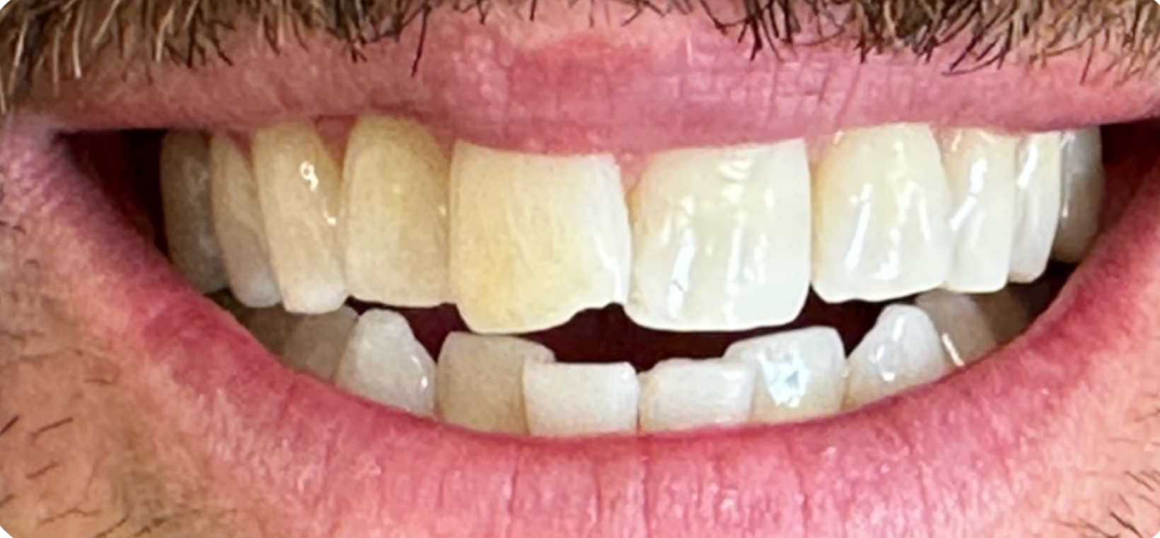 A close up of a man 's mouth with white teeth and a beard. before