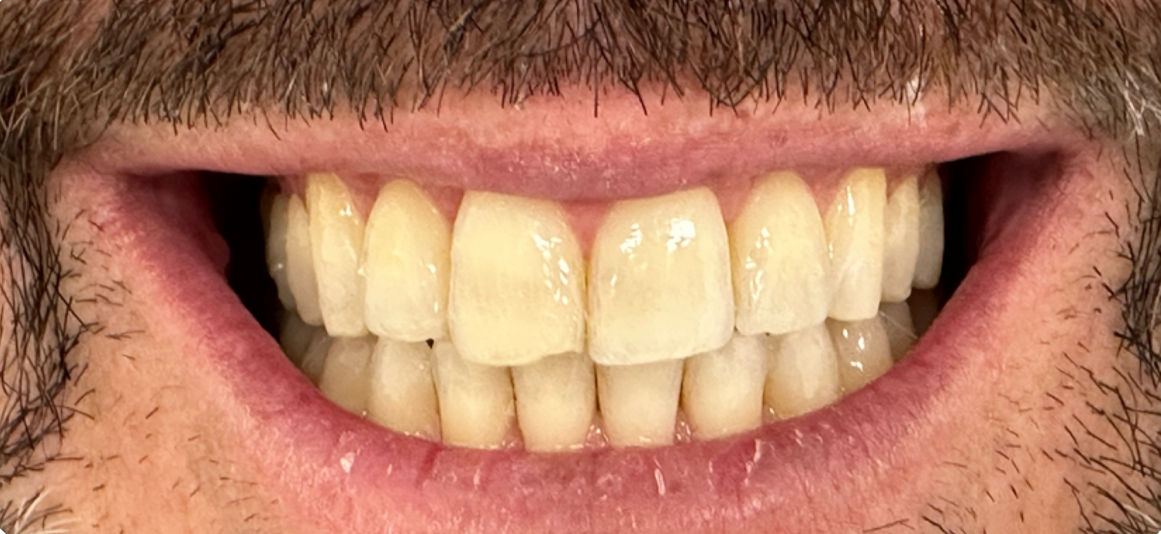 A close up of a man 's mouth with a beard and white teeth. after