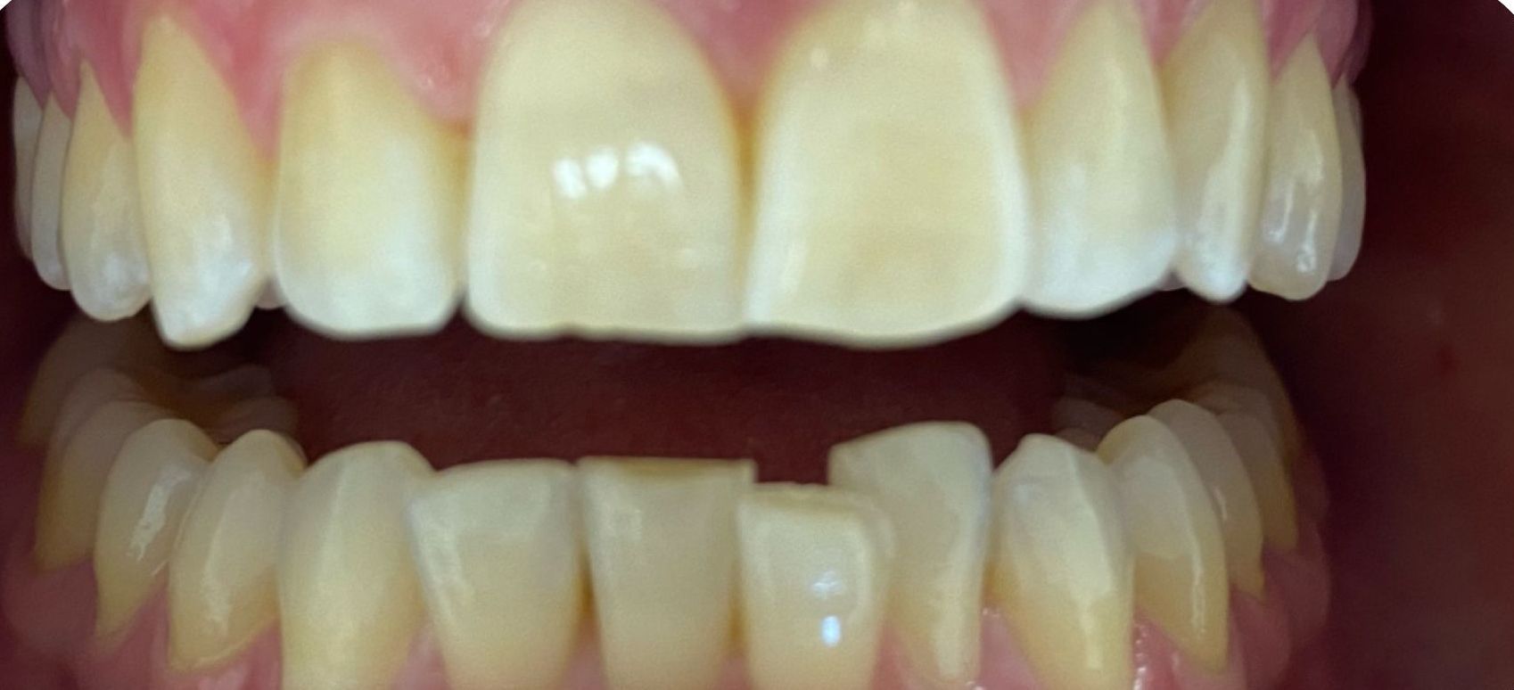 A close up of a person 's teeth with white teeth. before