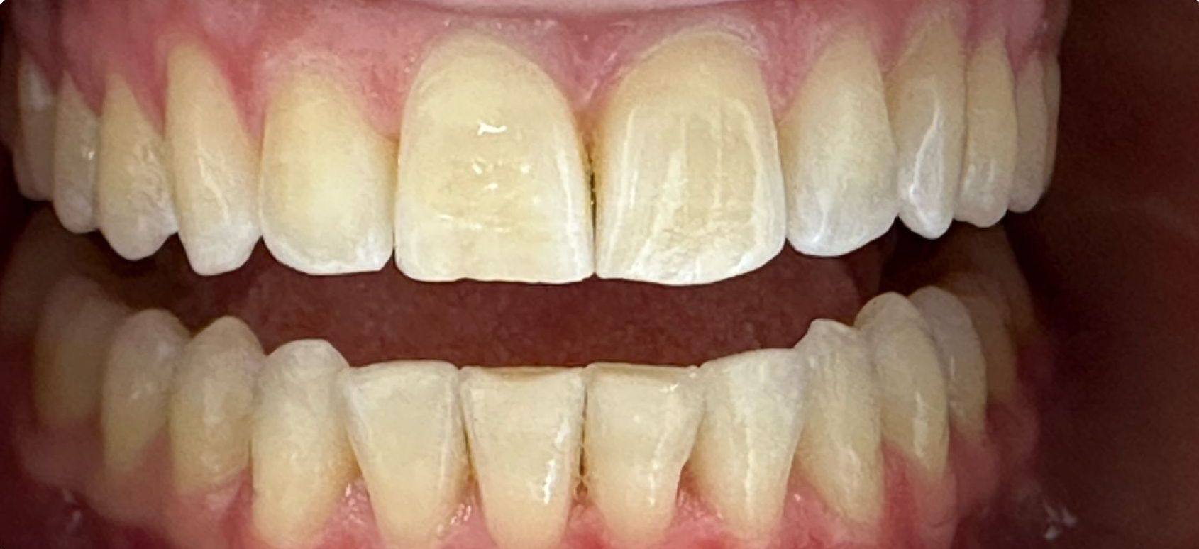 A close up of a person 's teeth with white teeth. after