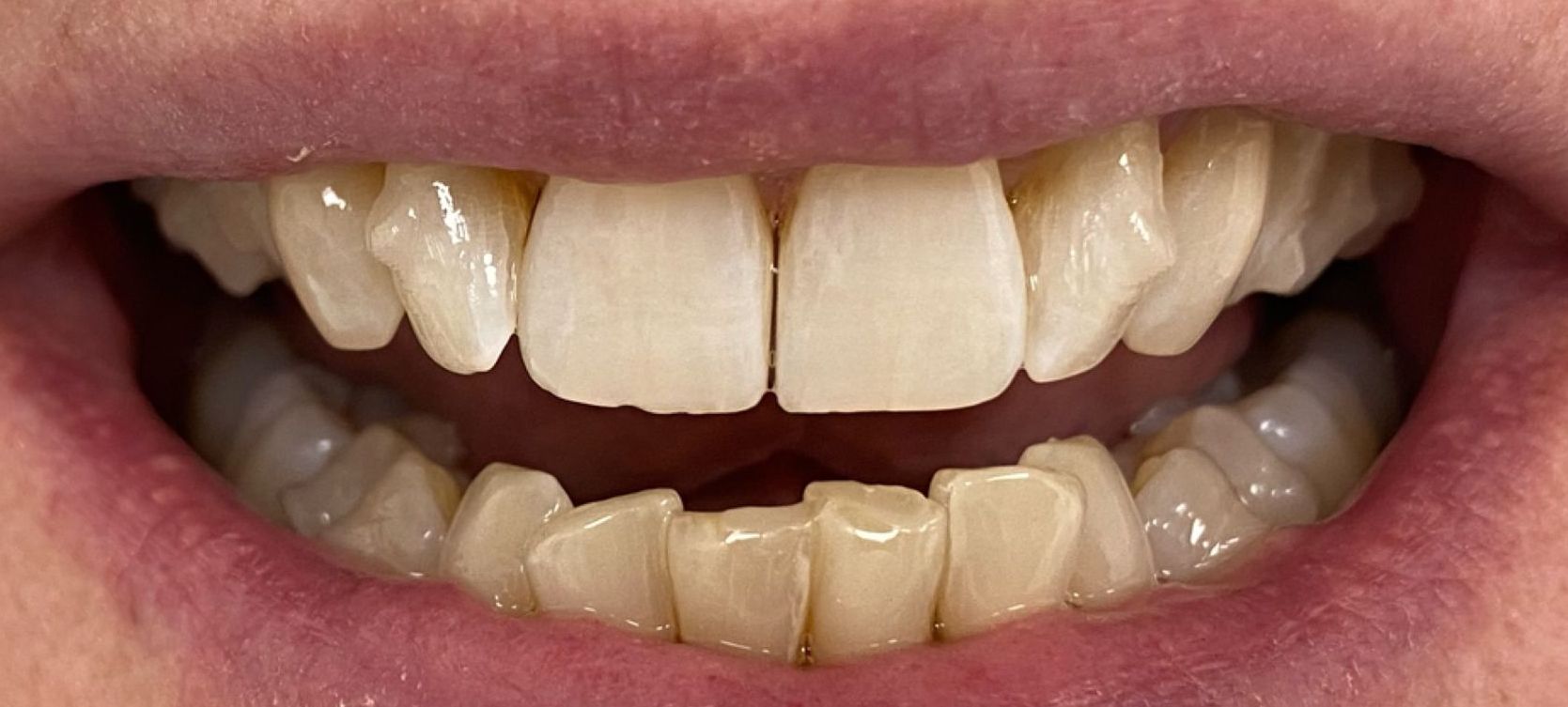 A close up of a person 's teeth with a missing tooth. before