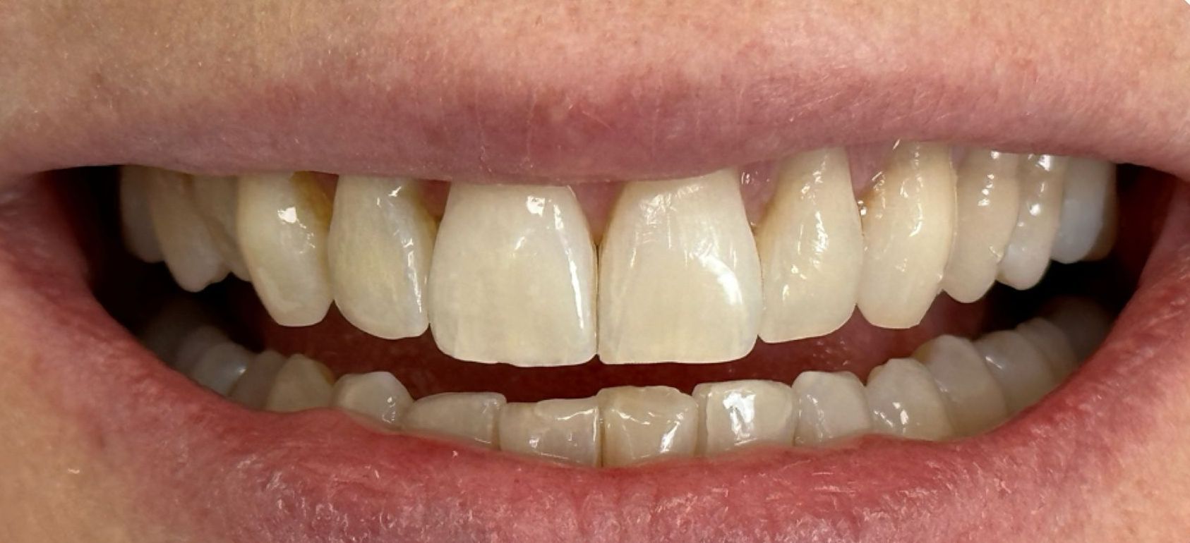 A close up of a person 's mouth with white teeth. after