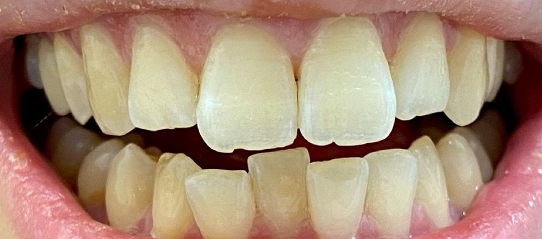 A close up of a person 's teeth with white teeth. before