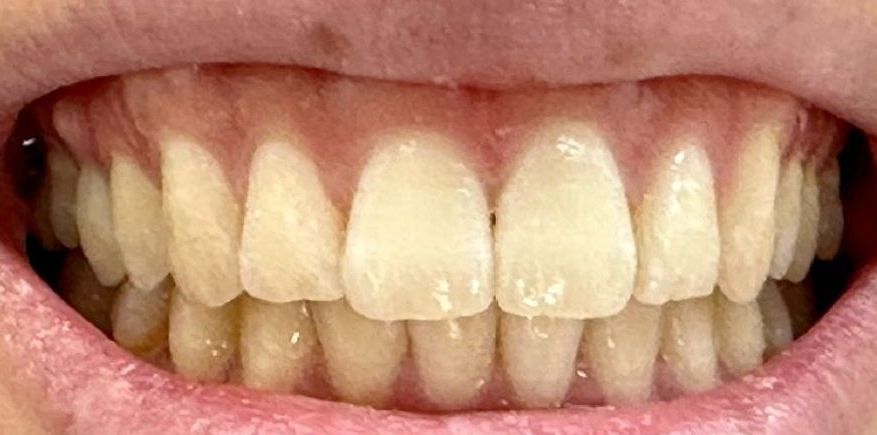 A close up of a person 's mouth with white teeth. after