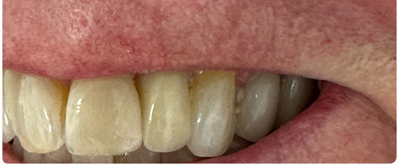 Close-up of yellowed front teeth with a visible gap and reddish gums