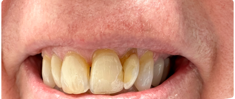 Close-up of teeth with yellowed front teeth and gums visible in a smile
