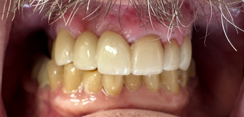 Close-up of open mouth showing upper and lower teeth with off-white discoloration and gums
