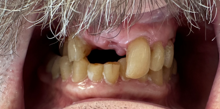 Close-up of severely damaged, missing front teeth with exposed gums and worn, discolored teeth.