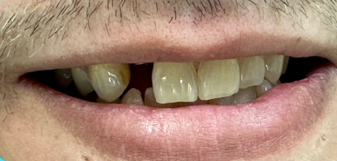Close-up of a smiling mouth with a gap between the front teeth.