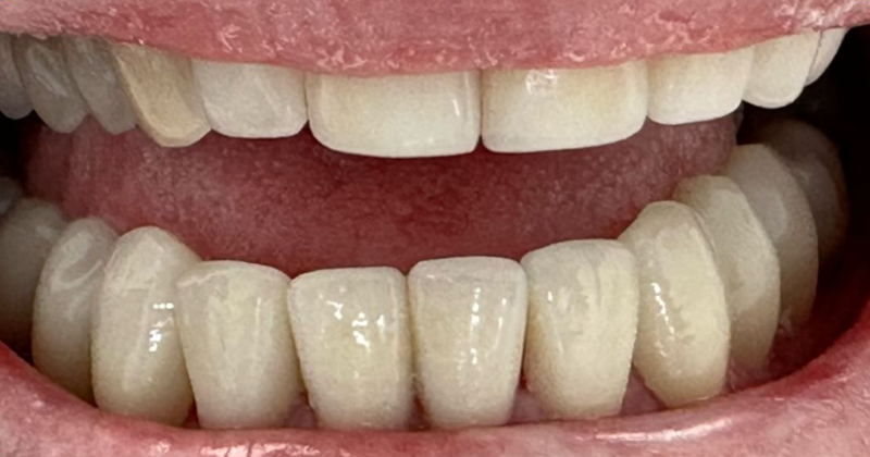 Close-up of a smiling mouth showing white upper and lower teeth