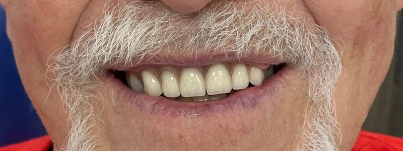 Close-up of a smiling mouth with white mustache and teeth against a blue background
