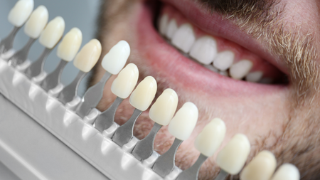 A close up of a man 's teeth next to a tooth color chart.