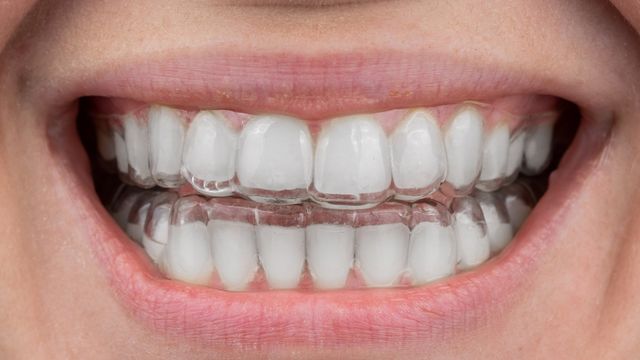 What Are Invisible Braces? Do Invisible Braces Work?