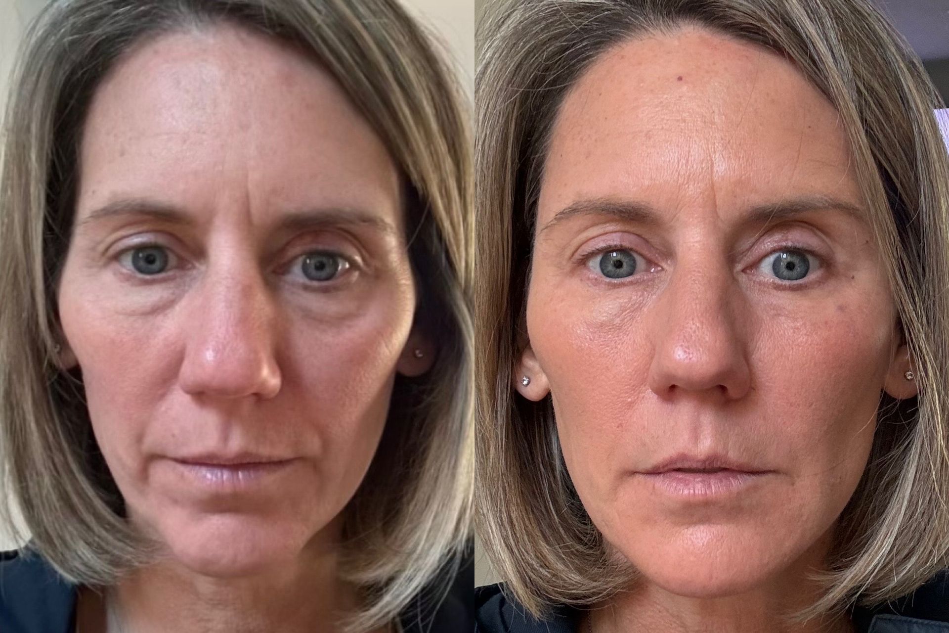 Side-by-side comparison showing a woman's face before and after a procedure, with reduced wrinkles and improved skin tone.