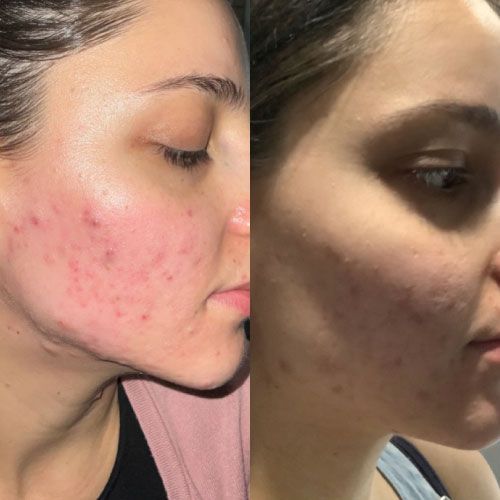 Acne Treatment Before and After