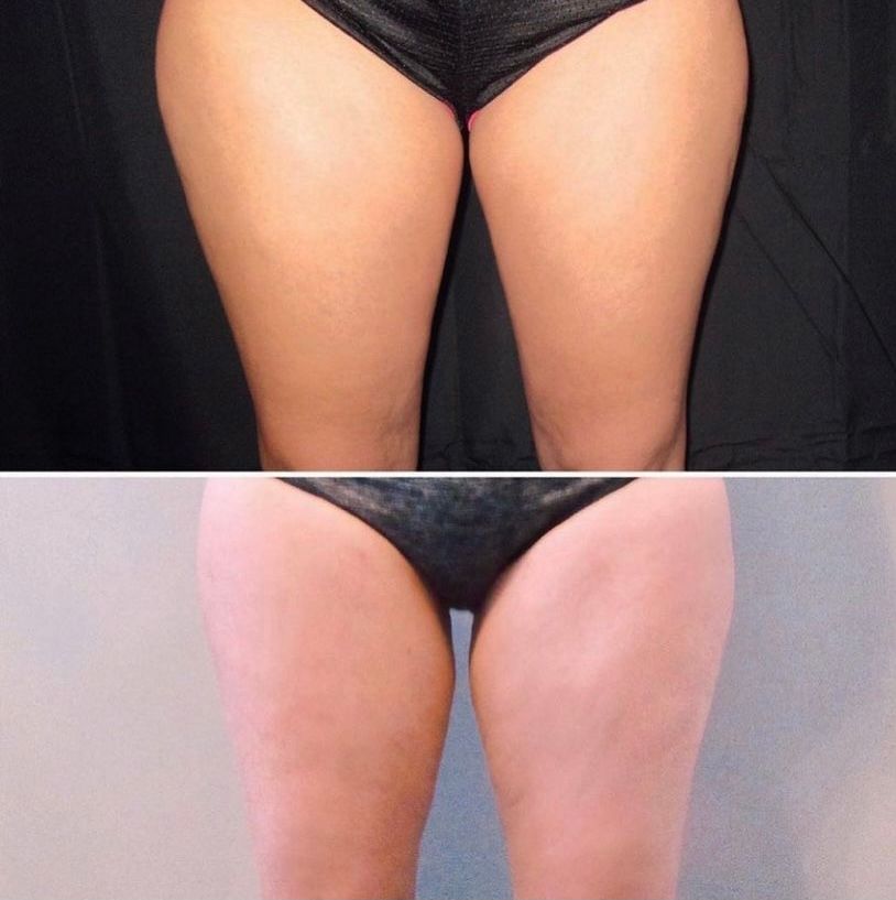 CoolSculpting Before and After