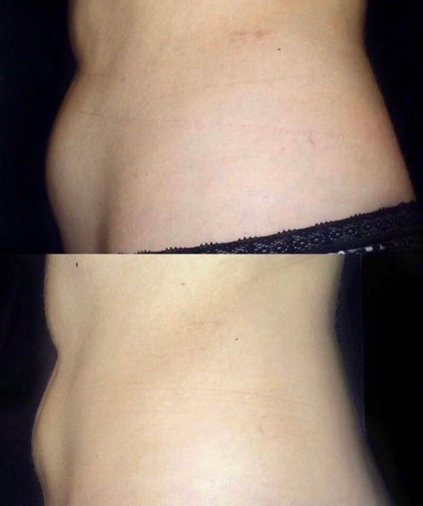 CoolSculpting Before and After