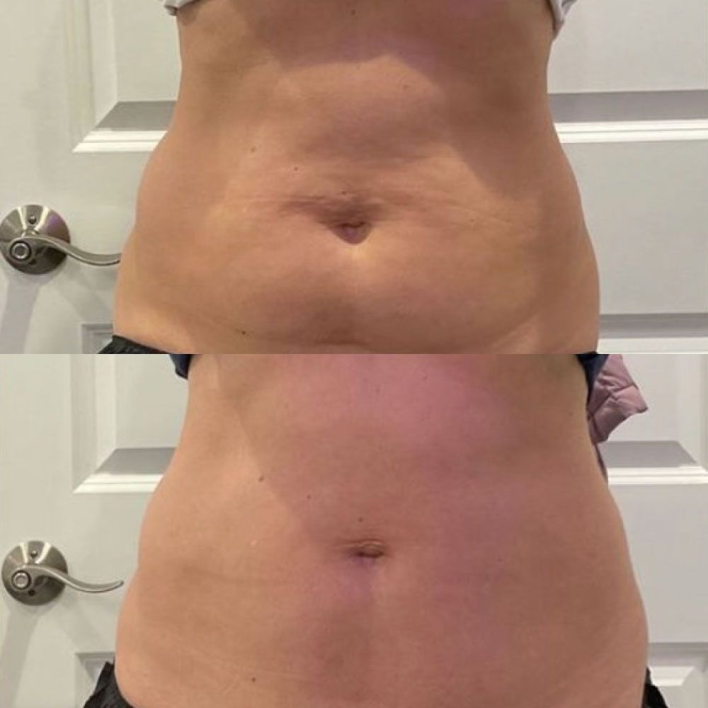 CoolSculpting Before and After