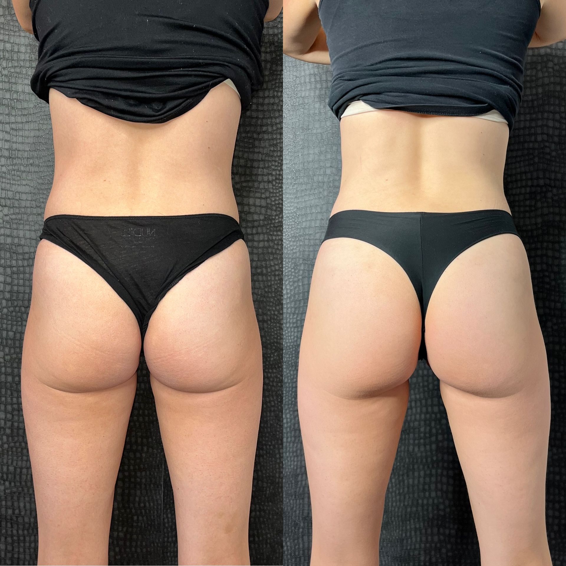 Radiesse Booty Before and After