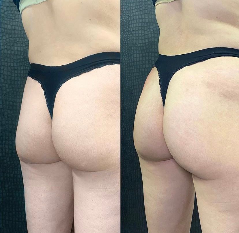 Radiesse Booty Before and After