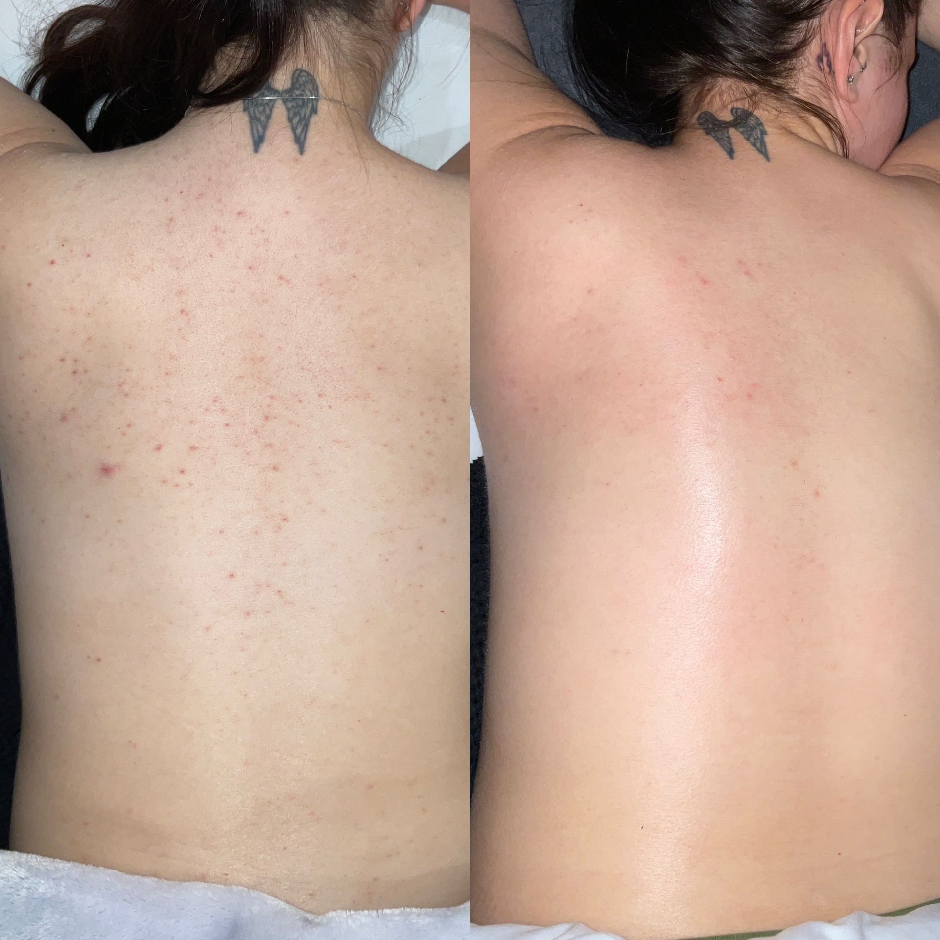 Back Attack Before and After