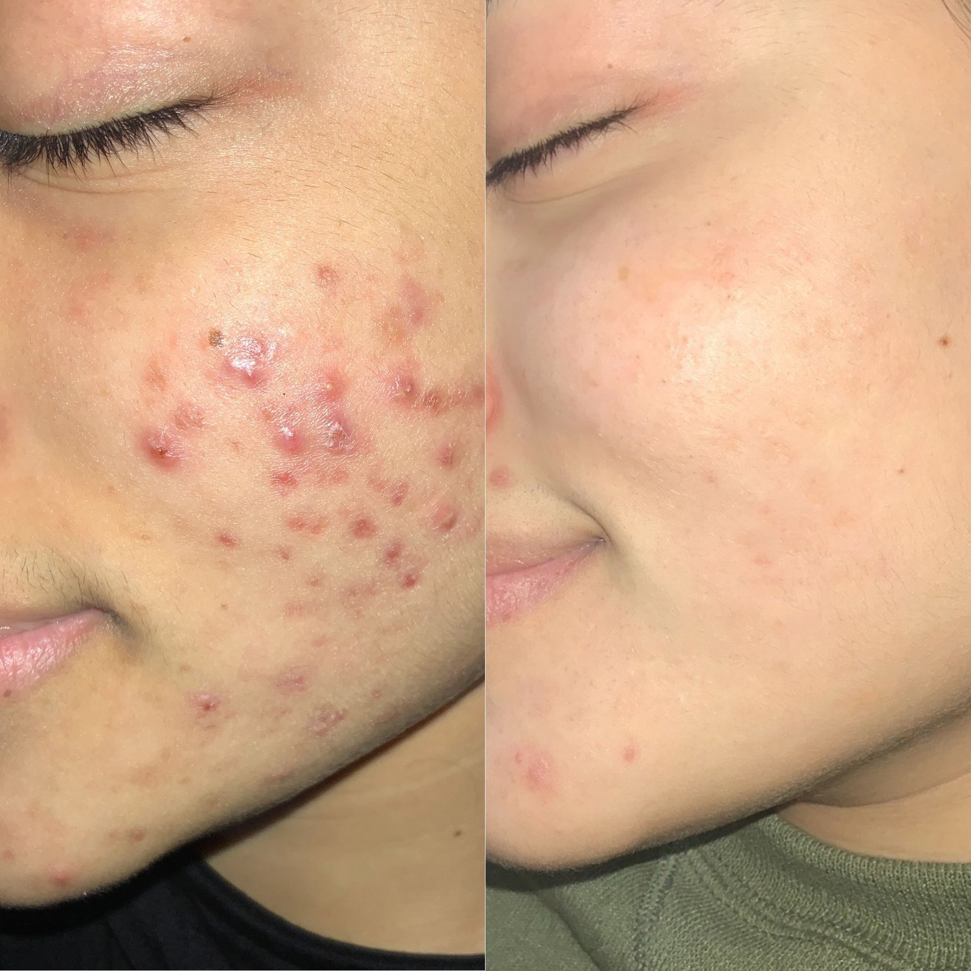 Acne Treatment Before and After