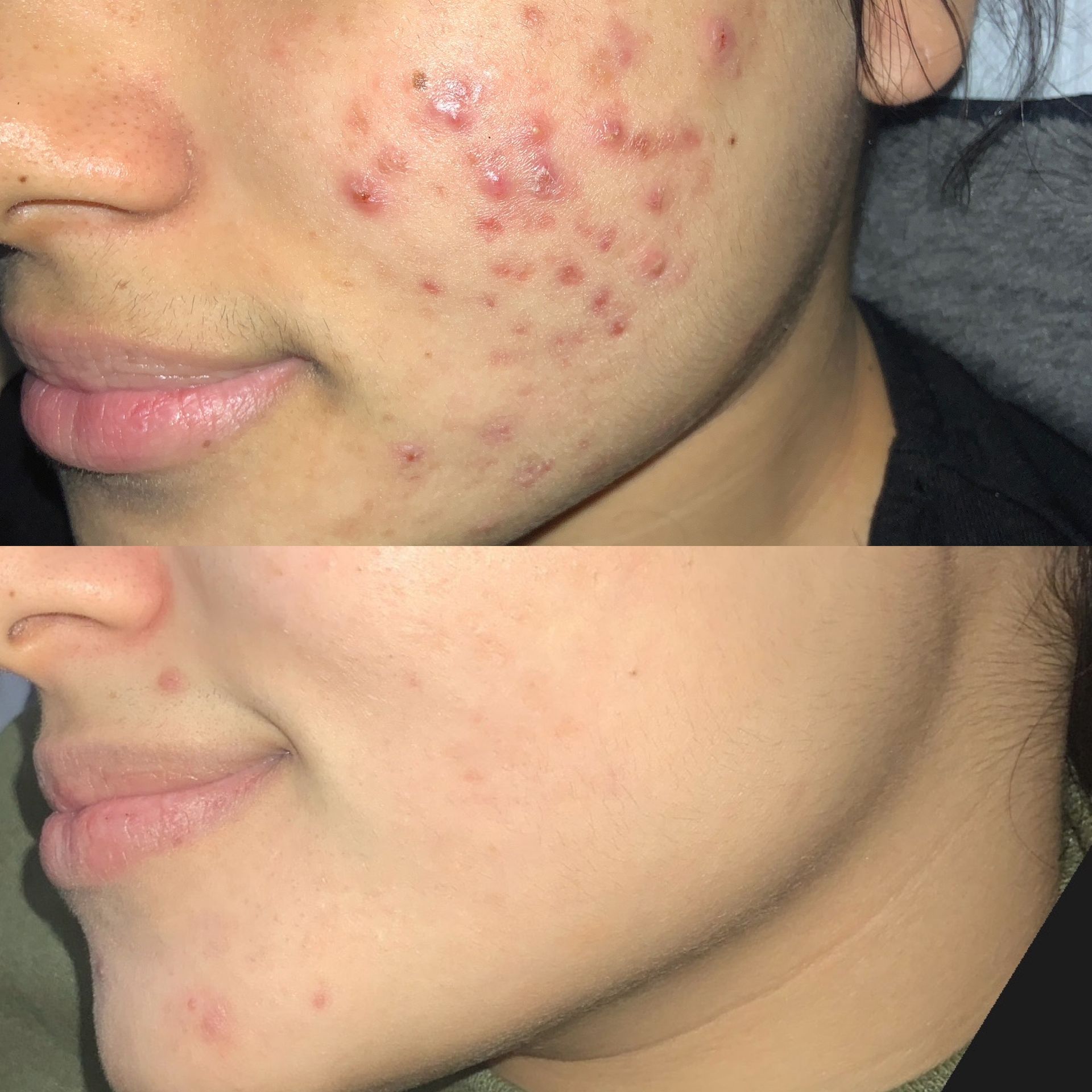 Acne Treatment Before and After