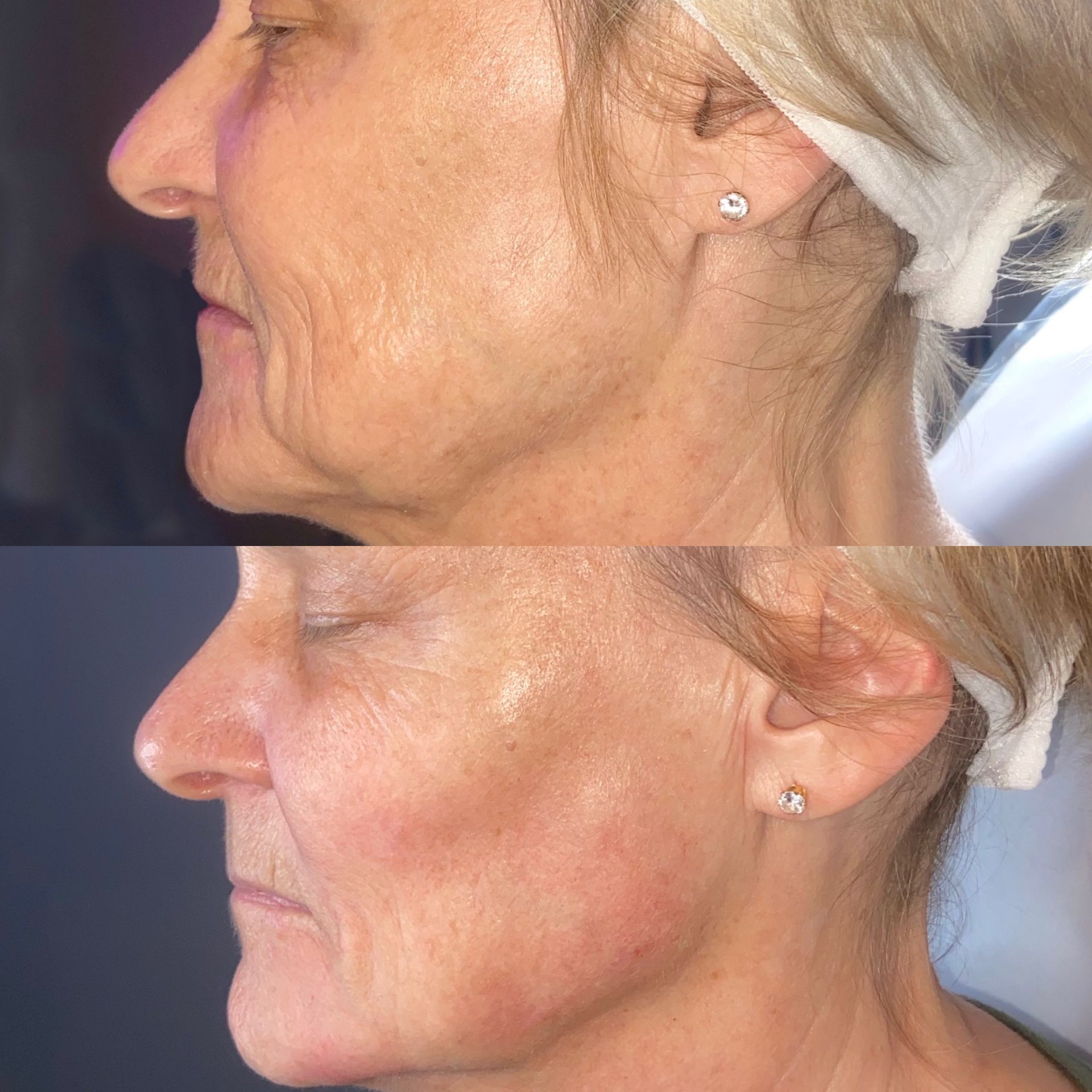 Facial Filler Before and After