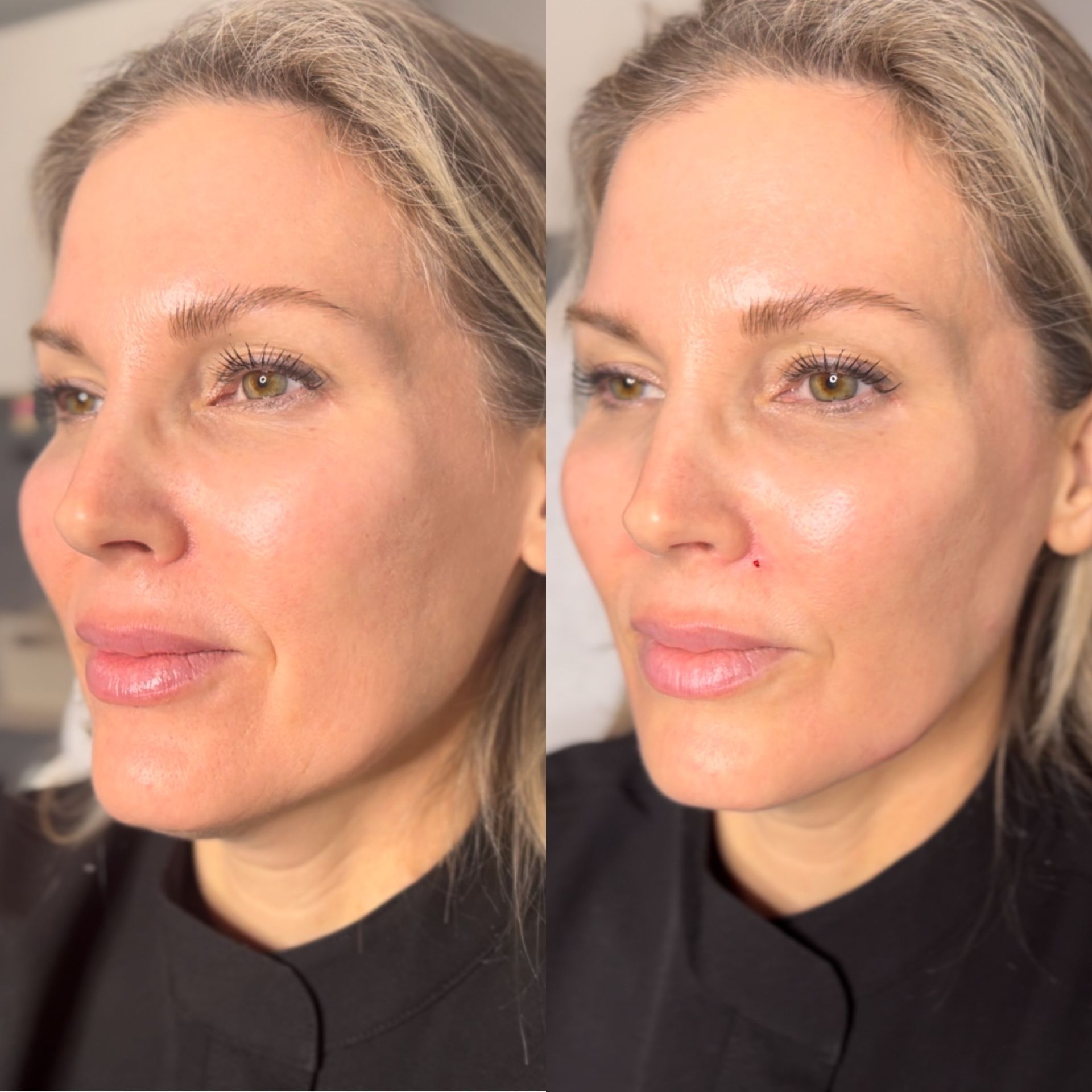 Facial Filler Before and After