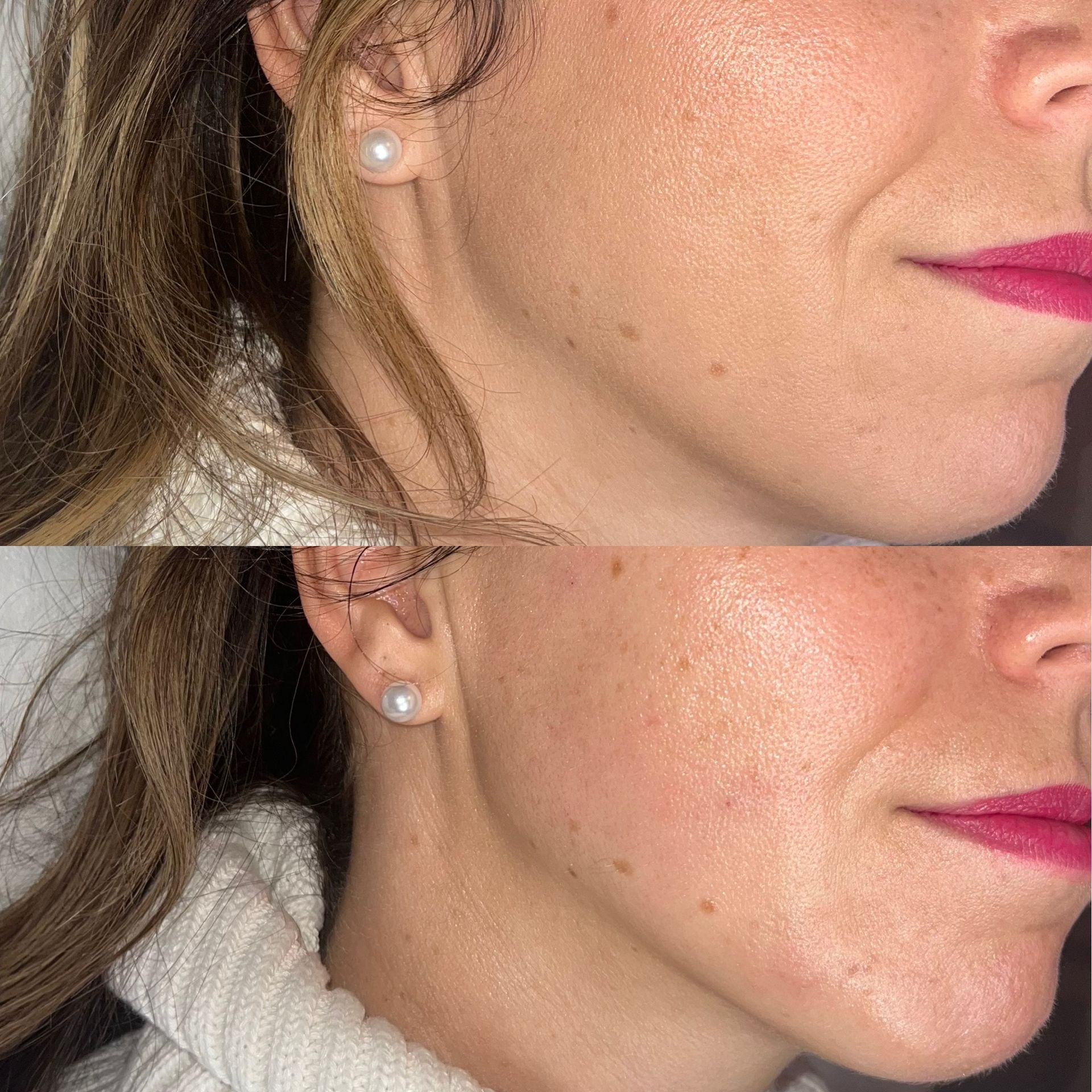 Facial Filler Before and After