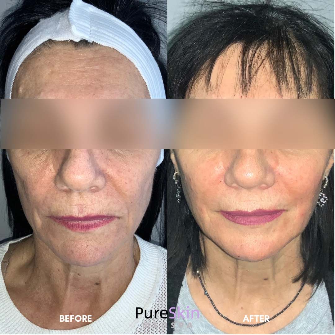 Facial Filler Before and After