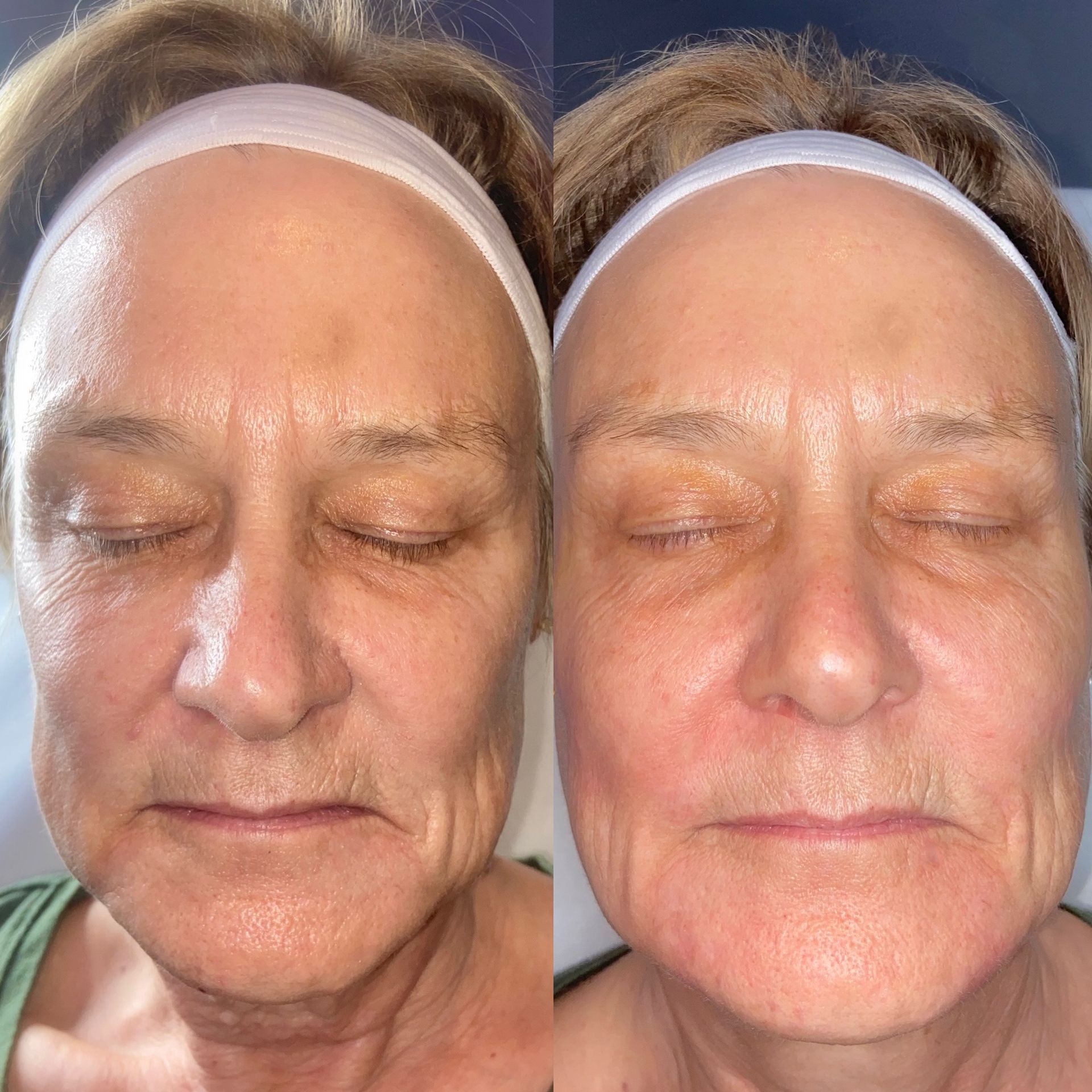 Facial Filler Before and After