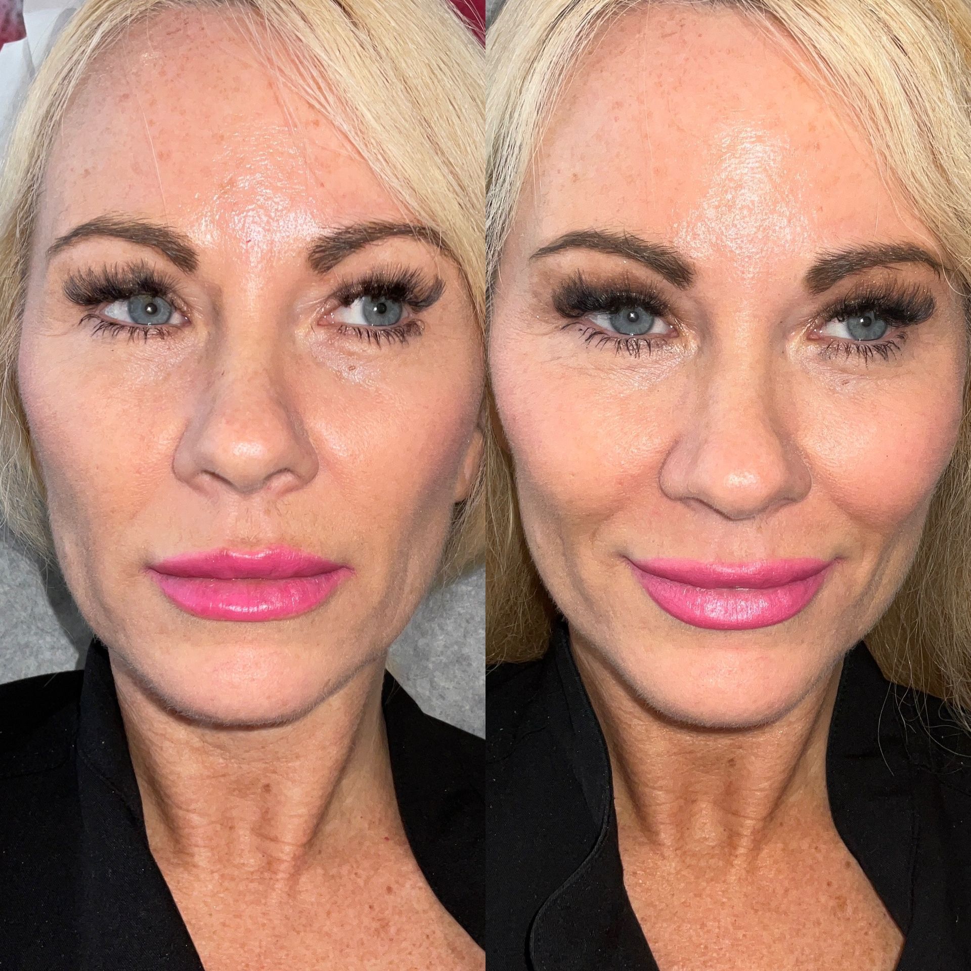 Facial Filler Before and After