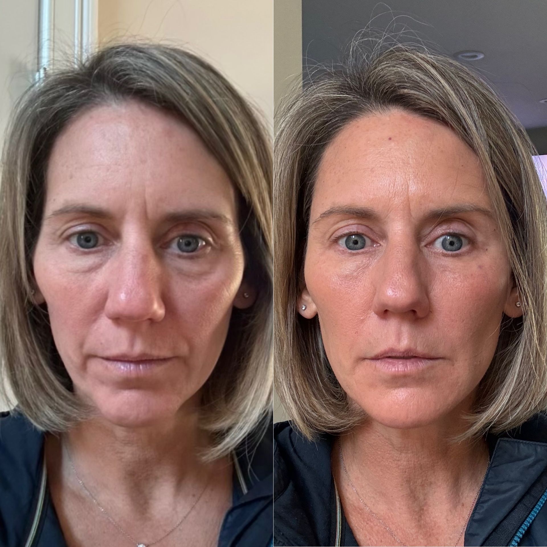 Facial Filler Before and After