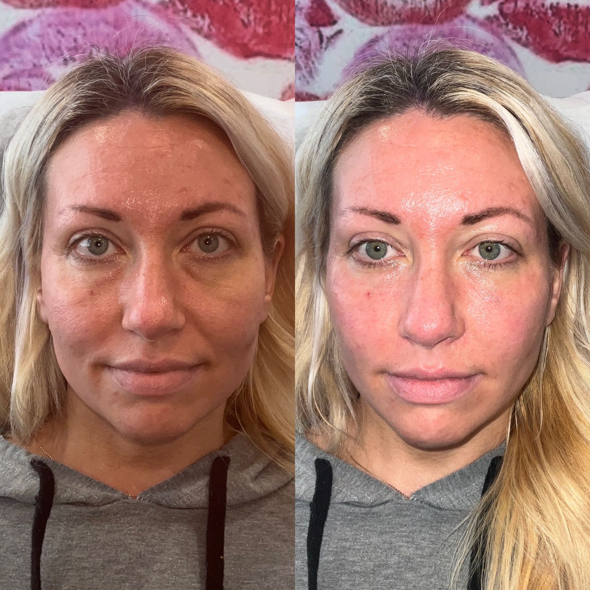 Facial Filler Before and After