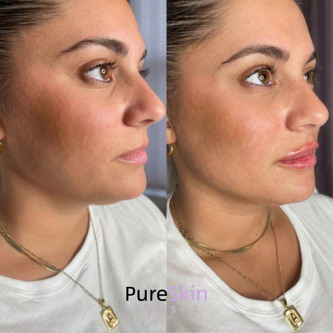 Facial Filler Before and After